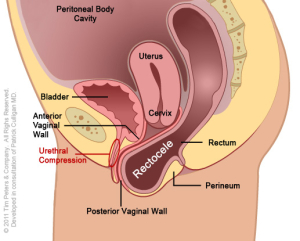 Rectocele-With-Uterus-Image-4-300x241